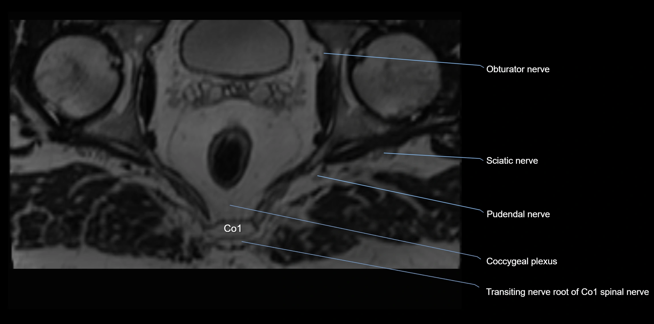 MR lumbosacral plexus axial cross sectional anatomy 3T  radiology  image-img-1008001-00122.webp